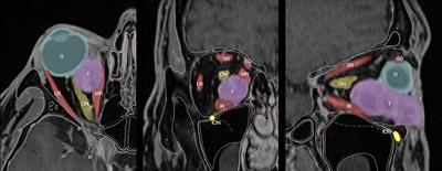 The Transantral Endoscopic Approach: A Portal for Masses of the Inferior Orbit—Improving Surgeons' Experience Through Virtual Endoscopy and Augmented Reality